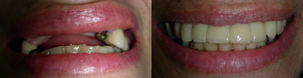 dental_implant6.png